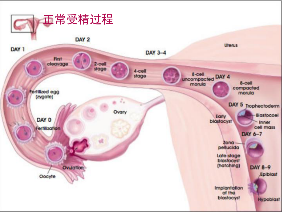 异位妊娠-课件.ppt_第3页