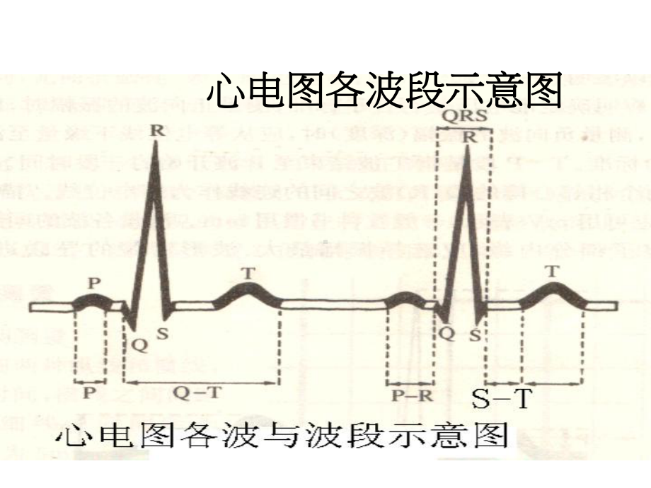 常见心电图分析(同名14)课件.ppt_第2页