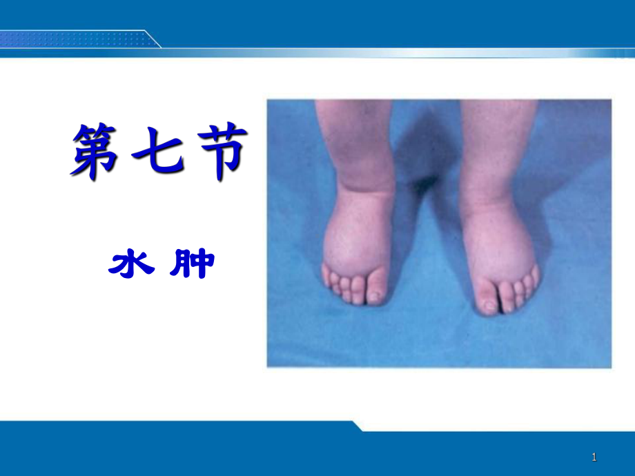 护理评估第四章水肿课件.ppt_第1页