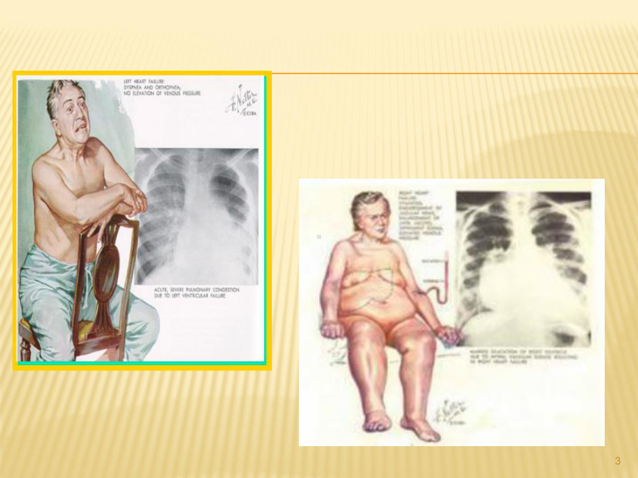 心力衰竭课件(同名558).ppt_第3页