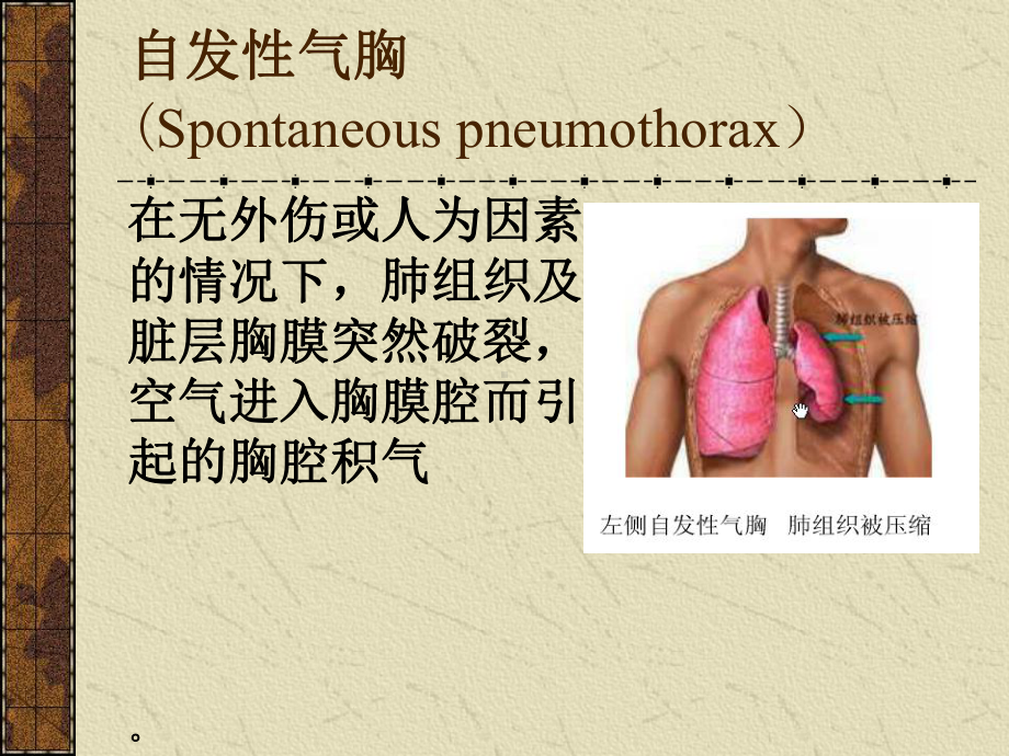 张力性气胸课件(同名556).ppt_第1页