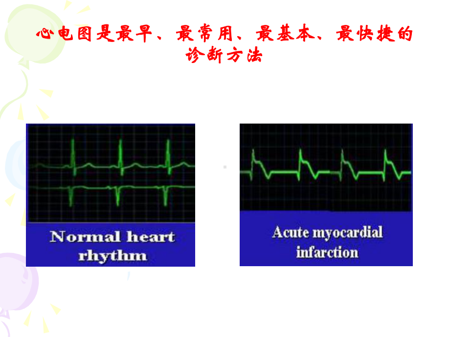 心电图在急性冠状动脉综合征中的应用地位与前景-上课件.ppt_第2页