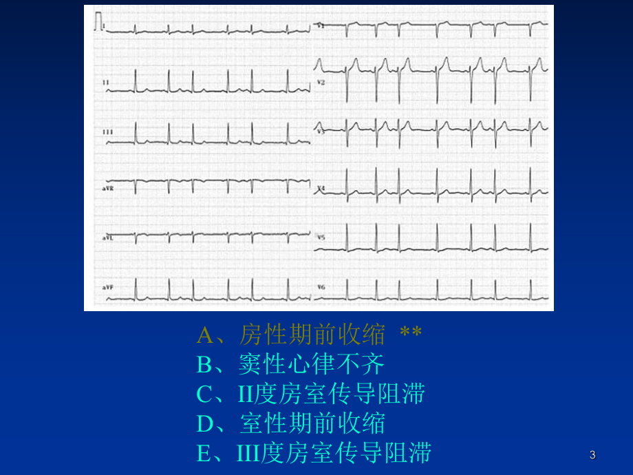 心电图规范化培训之辅助检查结果判读课件.ppt_第3页