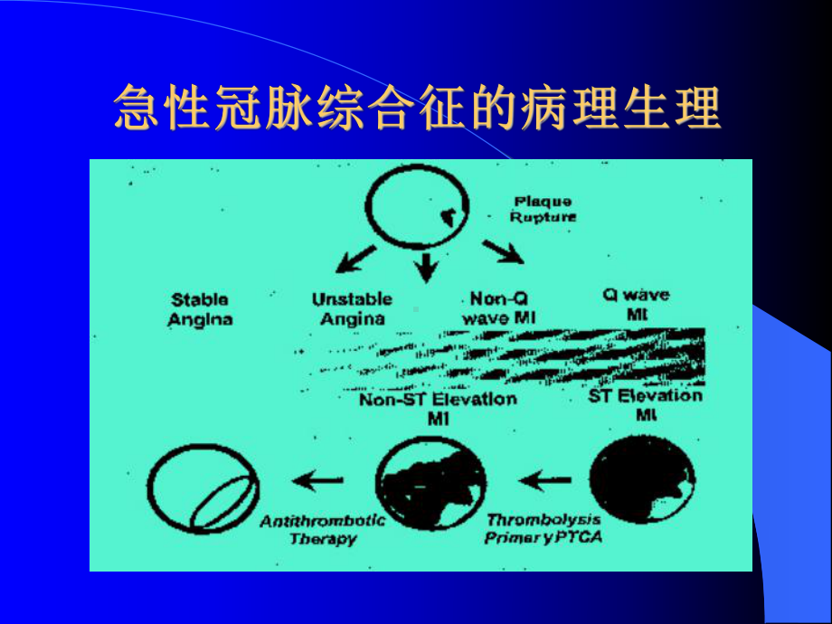 急性冠脉综合征诊断与治疗课件.ppt_第3页