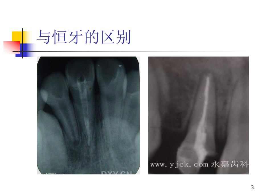 年轻恒牙牙髓疾病诊断与治疗课件.ppt_第3页