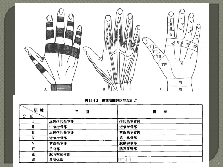 支具在锤状指康复中的应用-课件.ppt_第3页