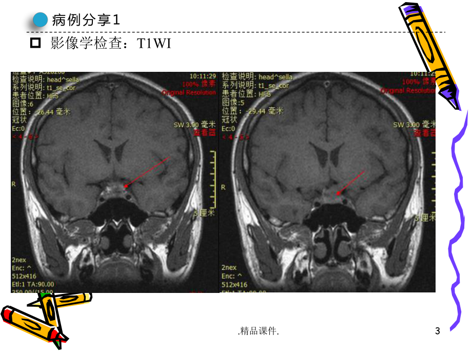 最新朗格汉斯细胞组织细胞增生症课件.pptx_第3页