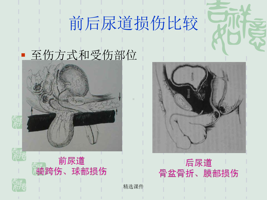 尿道损伤的治疗与护理-医学-精选课件.ppt_第3页