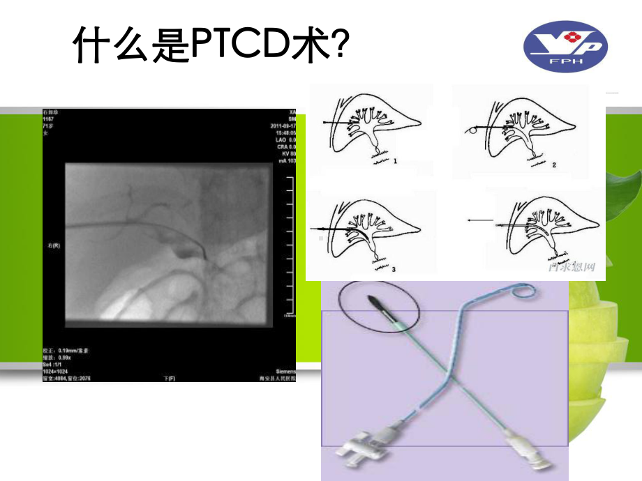 最新PTCD引流管的护理精选课件.ppt_第3页