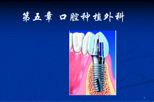 口腔颌面外科：第五章-口腔种植外科课件.ppt