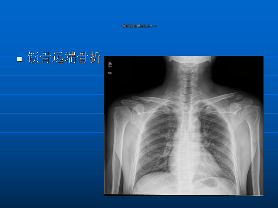 带袢钢板与ETHIBOND缝线双束1说课讲解课件.ppt_第2页