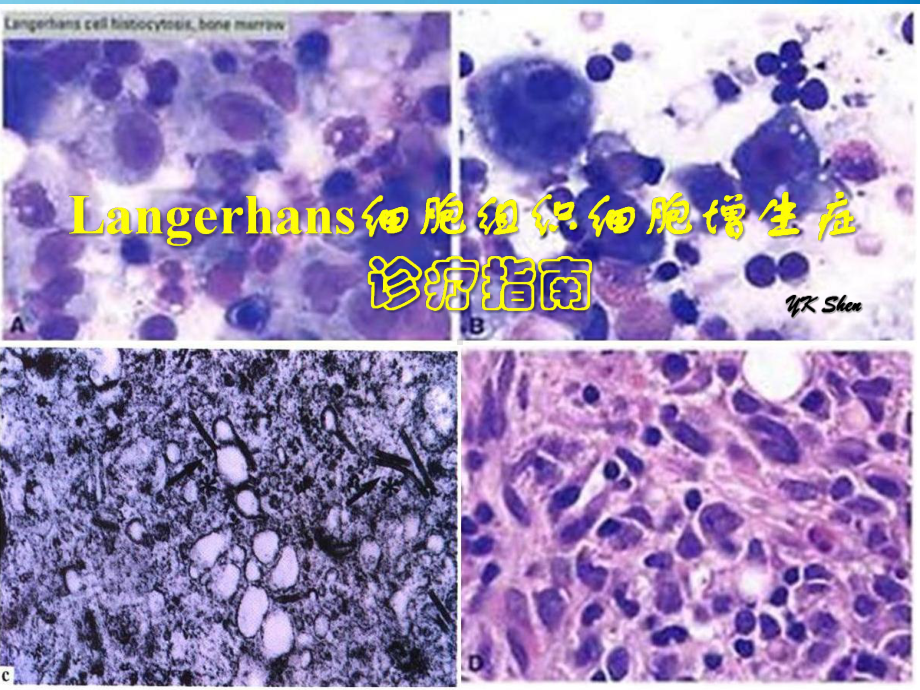 朗格罕细胞组织细胞增生症诊疗指南课件.ppt_第1页