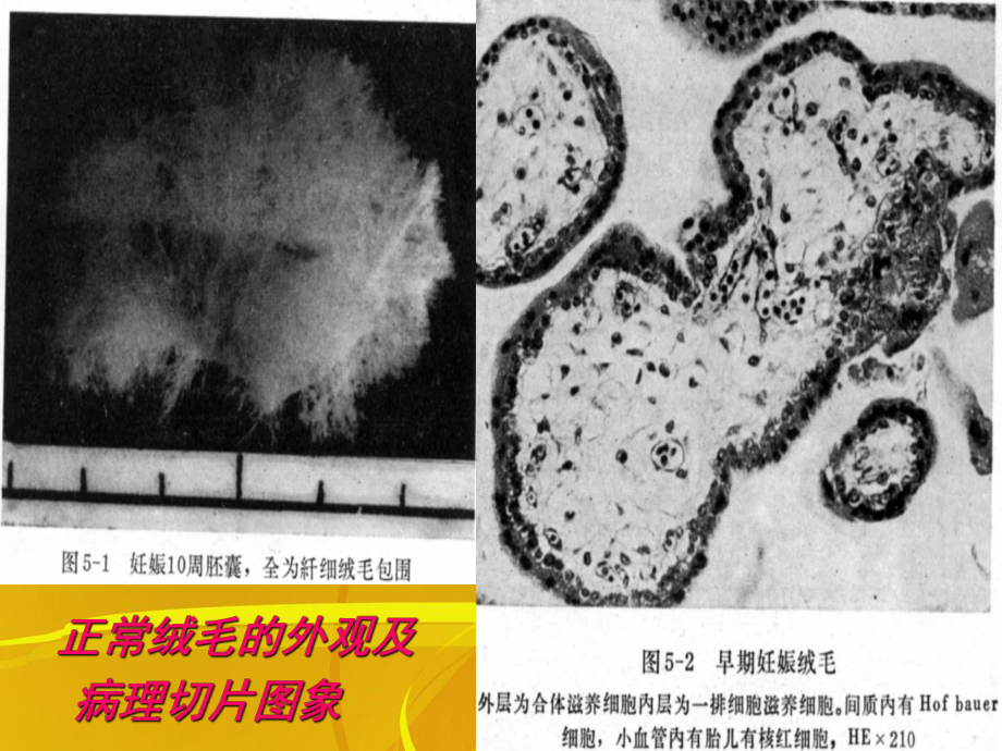 滋养细胞疾病病人的护理完整版课件.ppt_第3页