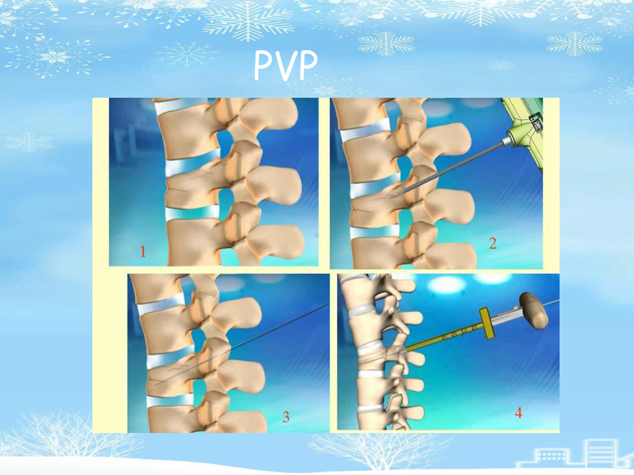 椎体成形术手术步骤2021完整版课件.ppt_第3页