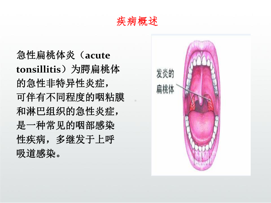 急性扁桃体炎的护理课件.ppt_第3页