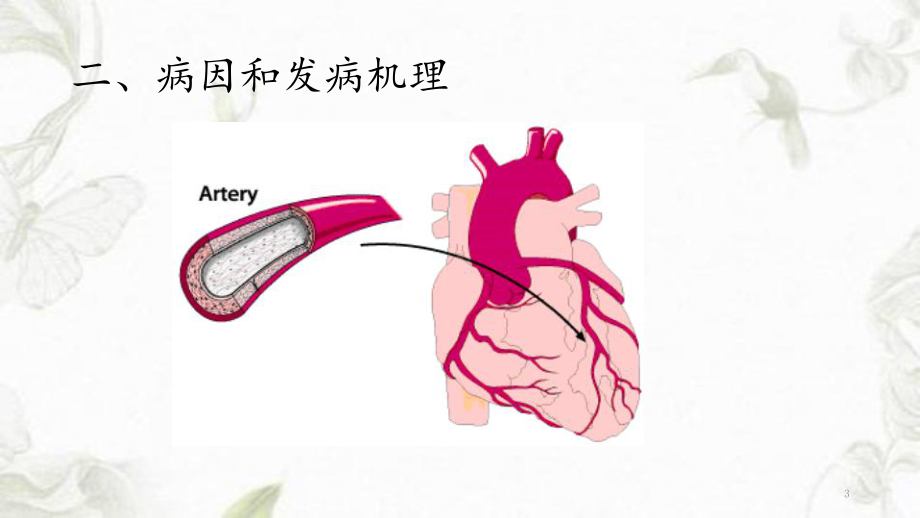 急性心肌梗死(学习重点)课件.ppt_第3页