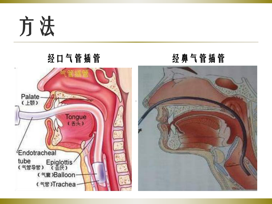 气管插管的护理课件讲义.ppt_第3页