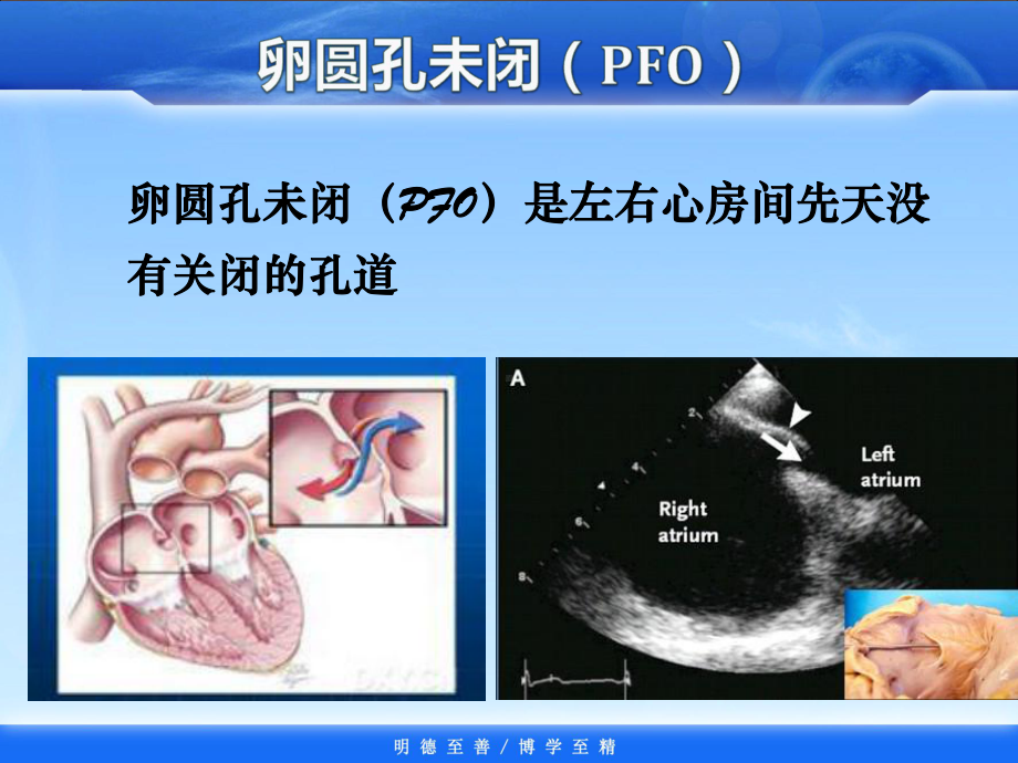 卵圆孔未闭封堵治疗课件.pptx_第1页