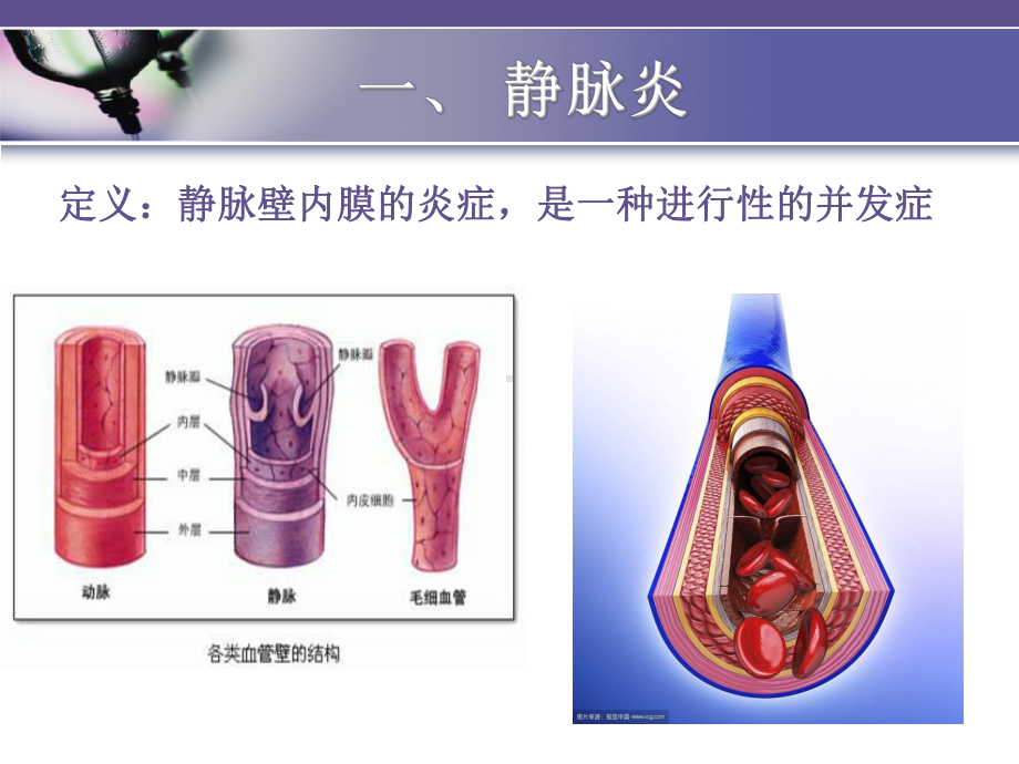 外周静脉治疗常见并发症教案资料课件.ppt_第3页