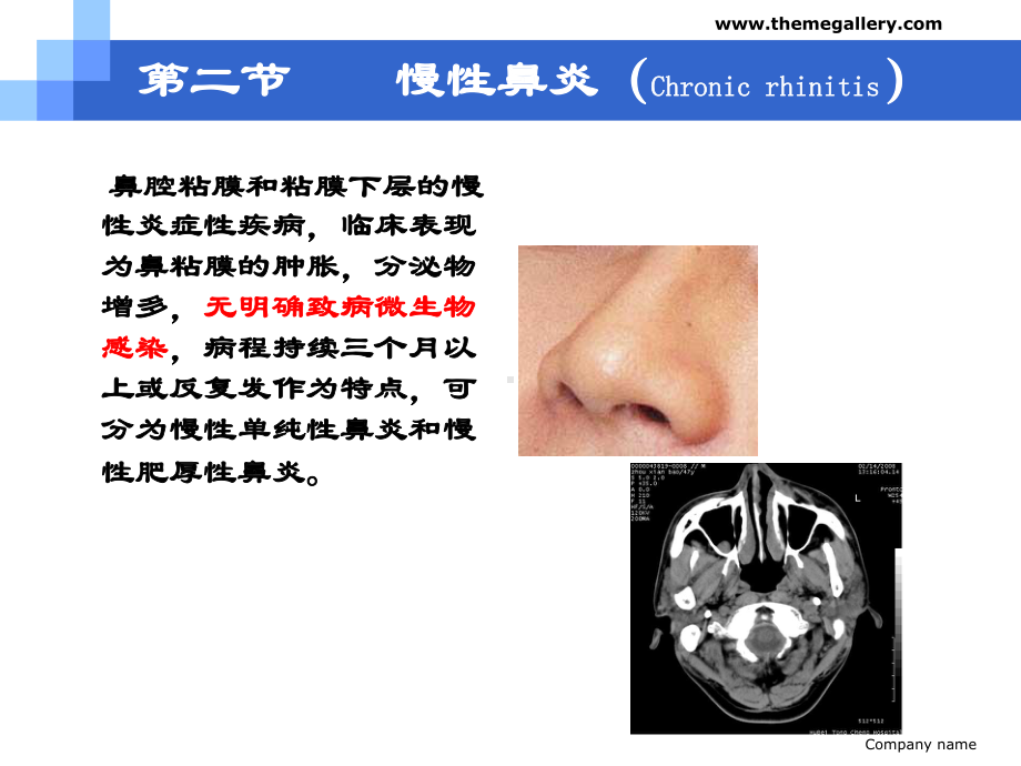 耳鼻喉18-1鼻炎病人护理.pptx_第3页