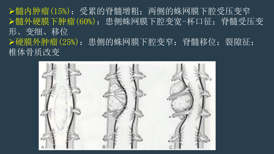 椎管内硬膜外海绵状血管瘤磁共振影像诊断课件.ppt_第3页