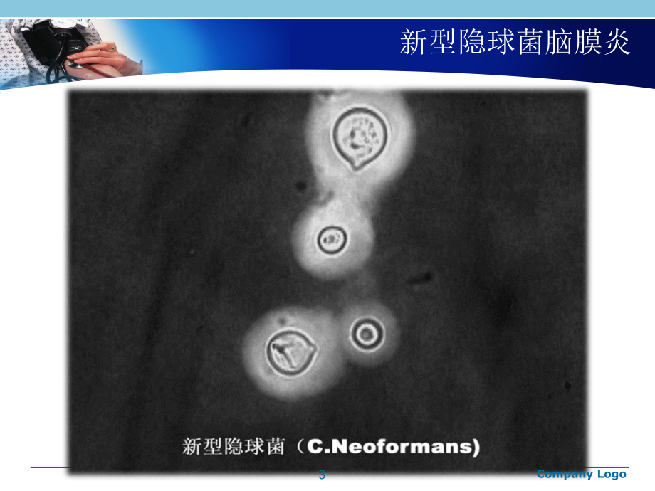 新型隐球菌脑膜炎参考教学课件.ppt_第3页