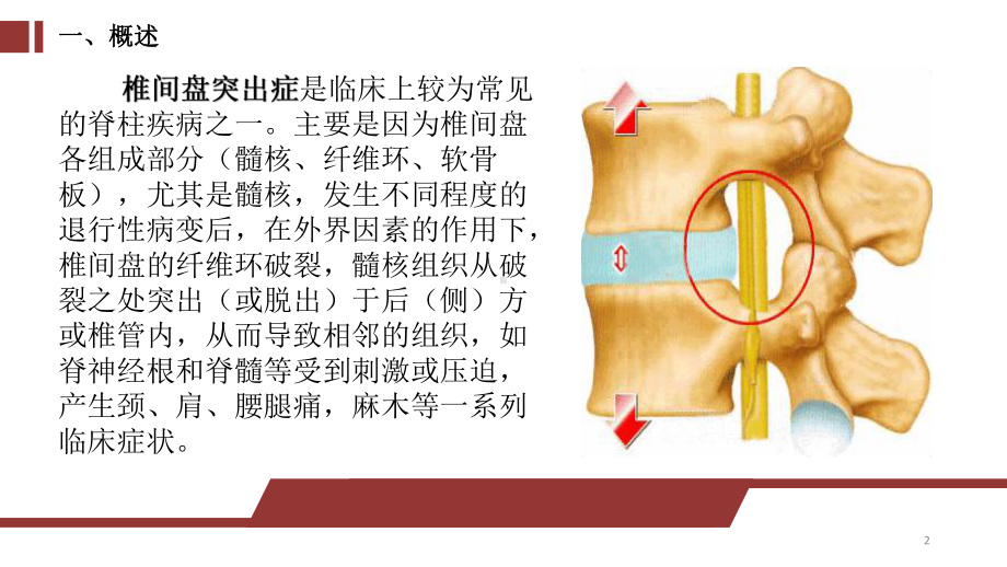 椎间盘突出课件.pptx_第2页