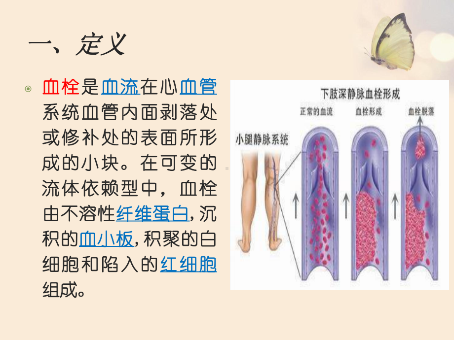 深静脉血栓的护理教材课件.ppt_第2页