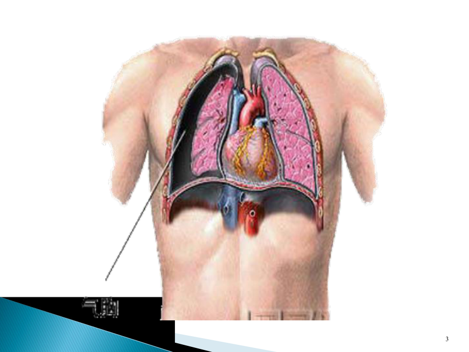 气胸的诊治2课件.ppt_第3页