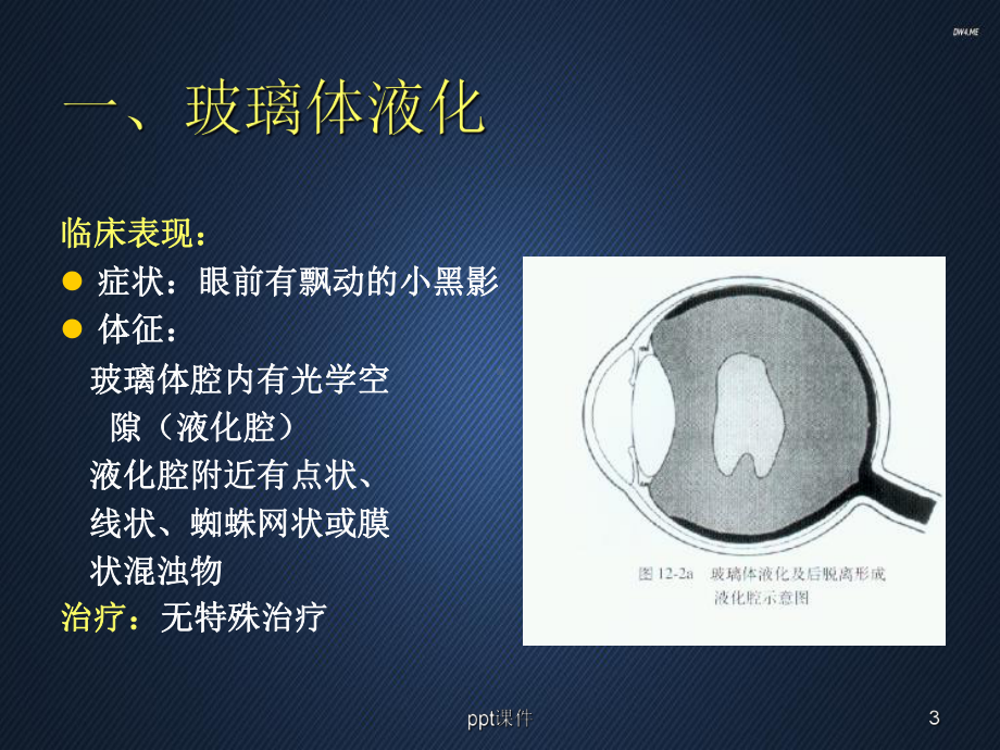 玻璃体疾病-课件.ppt_第3页