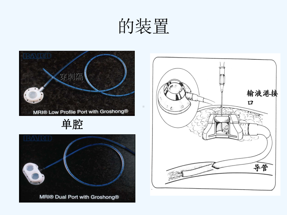 植入式静脉输液港临床应用及维护课件.ppt_第3页