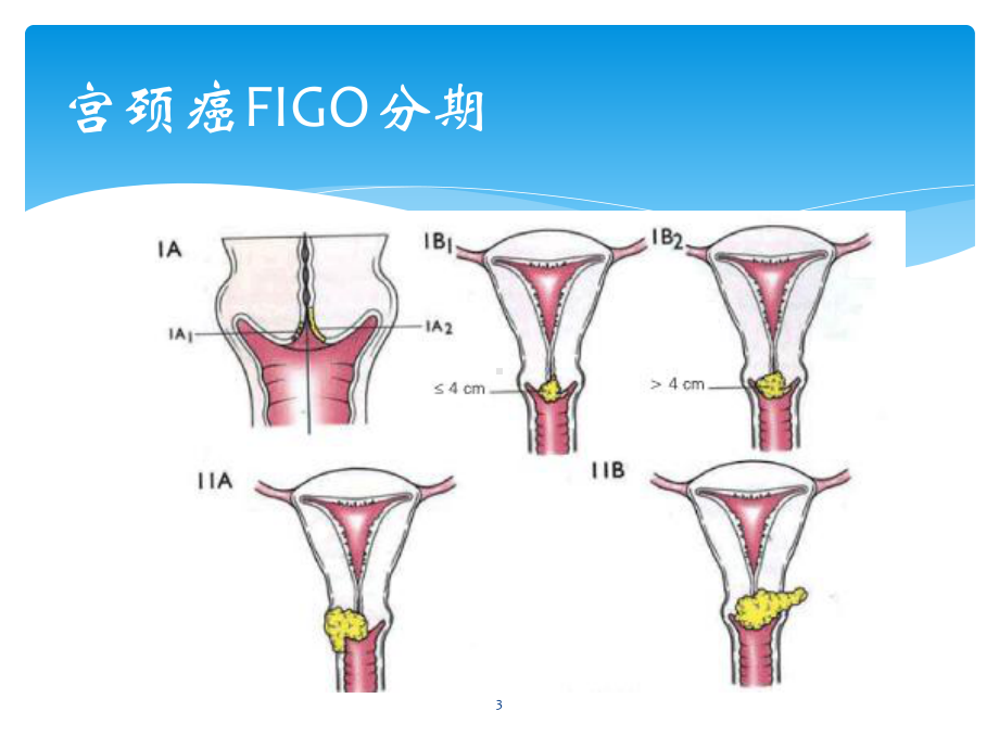 腹腔镜下广泛子宫切除术课件.ppt_第3页