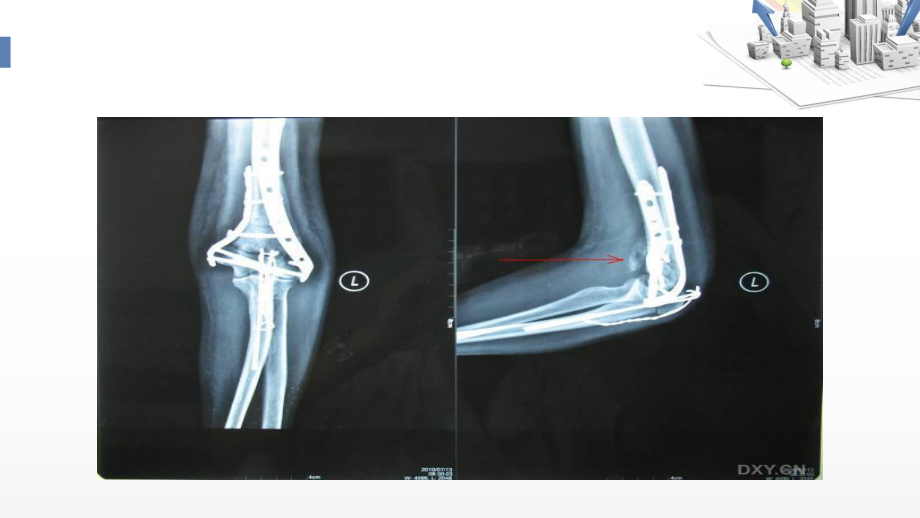 肘关节异位骨化治疗-课件.ppt_第3页