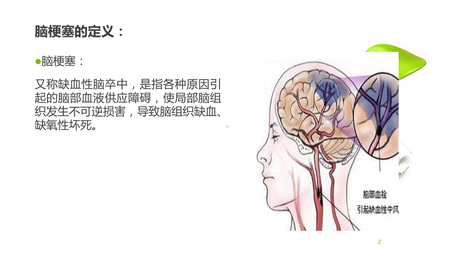 脑梗塞护理查房-课件.ppt_第2页