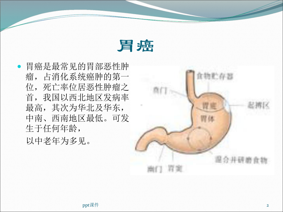 胃癌病人的护理查房（内科）-课件.ppt_第2页