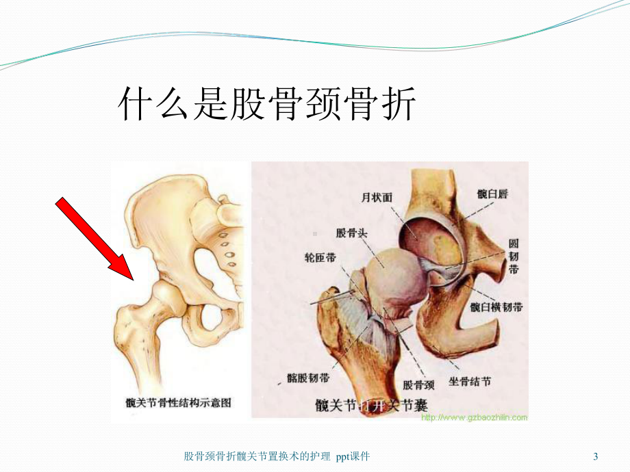 股骨颈骨折髋关节置换术的护理-课件.ppt_第3页