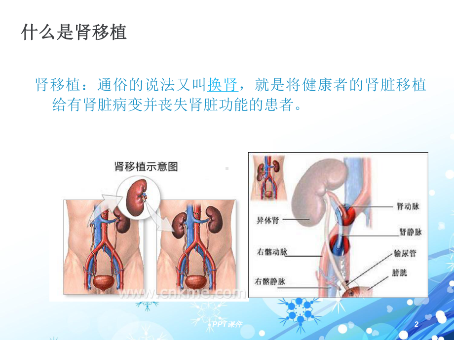 肾移植术后并发肺部感染护理查房-课件.ppt_第2页