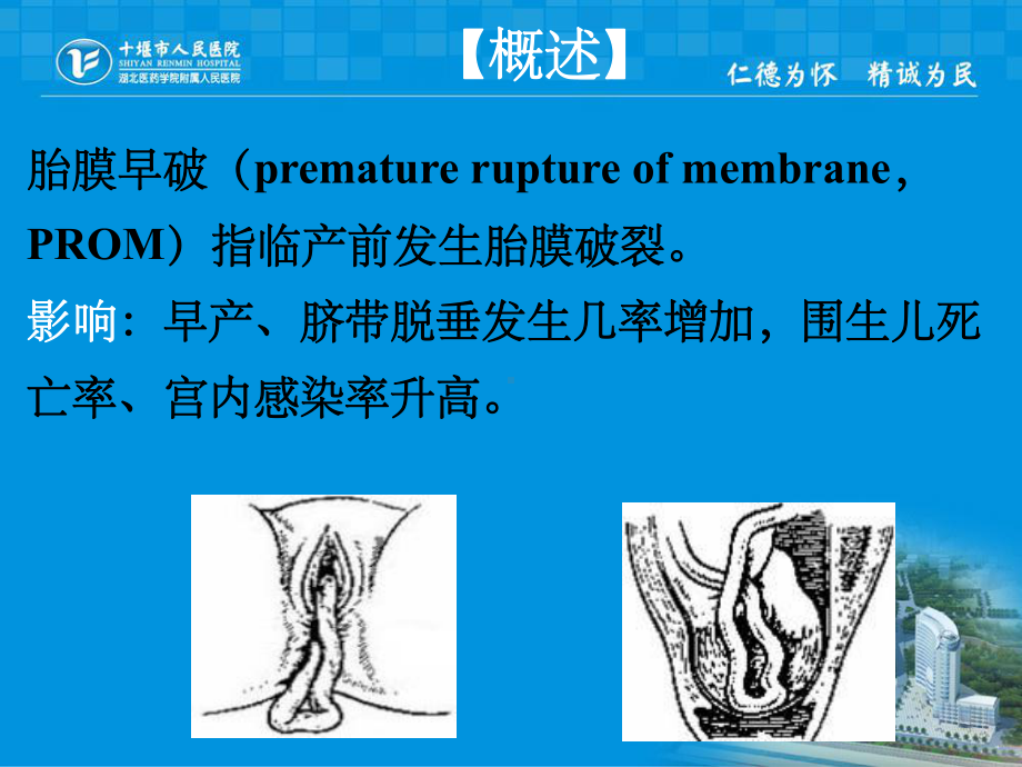 胎膜早破的护理72986课件.ppt_第2页