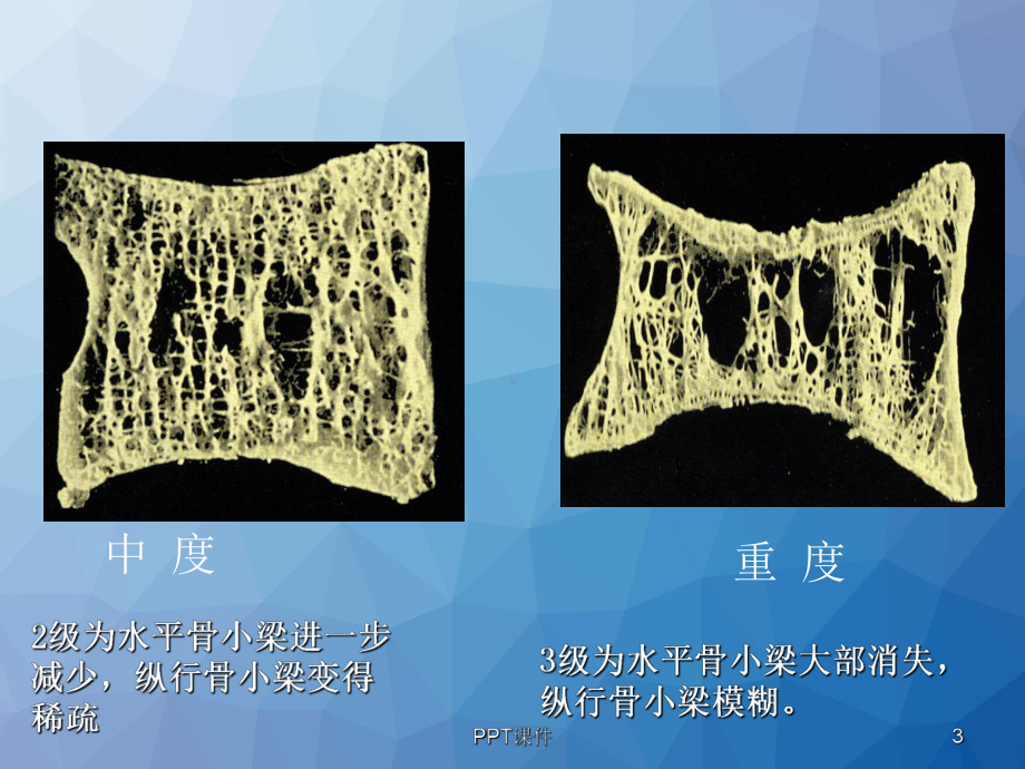 糖尿病性骨质疏松症-课件.ppt_第3页