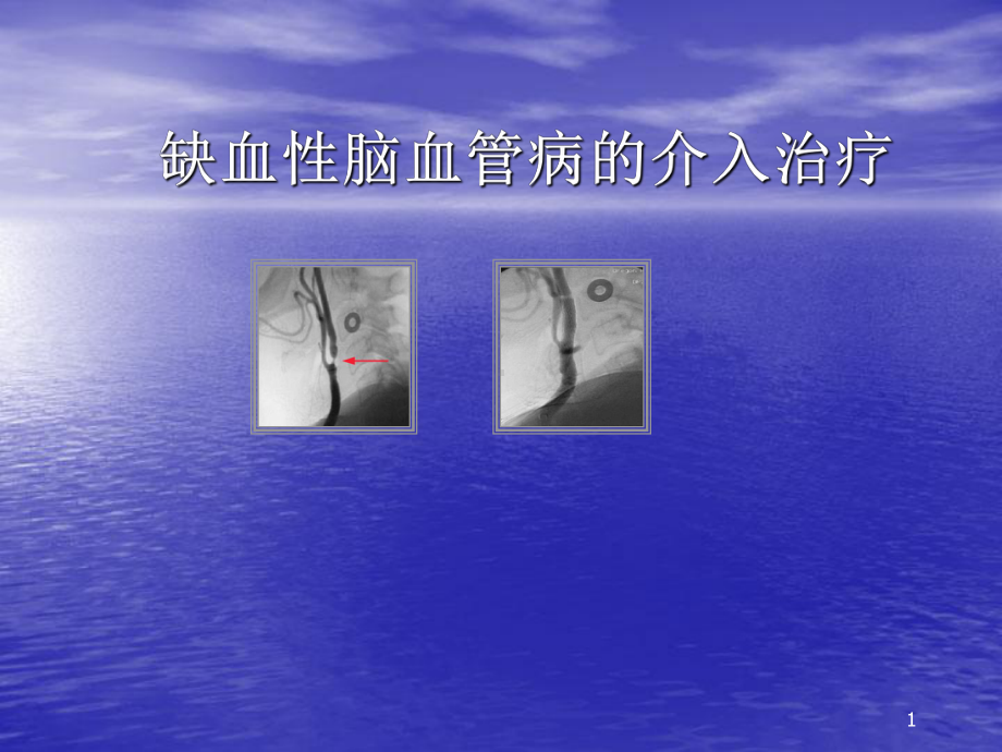 缺血性脑血管病的介入治疗课件(同名752).ppt_第1页