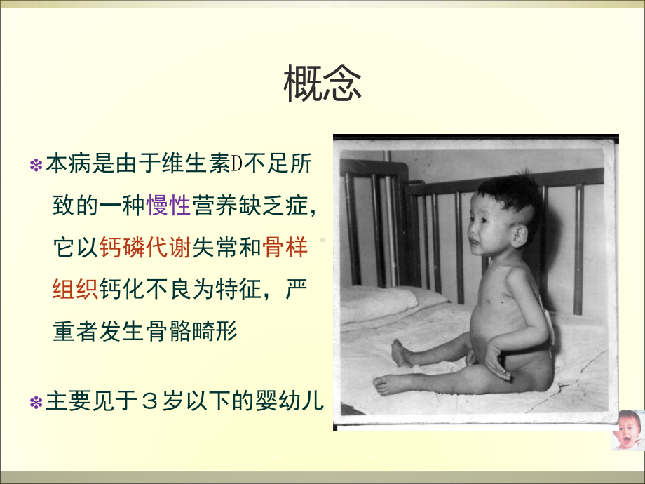 维生素D缺乏性佝偻病(小讲课)课件.ppt_第2页