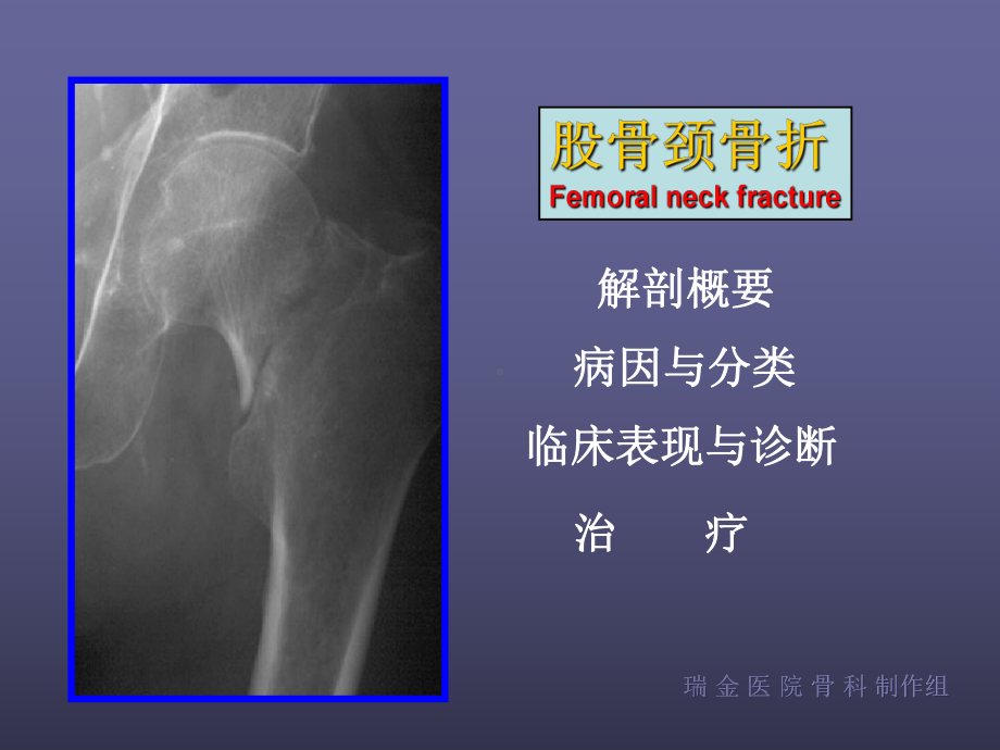 股骨颈骨折-课件-.ppt_第1页