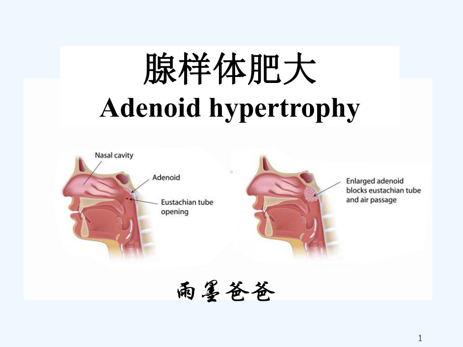 腺样体肥大-课件.ppt_第1页