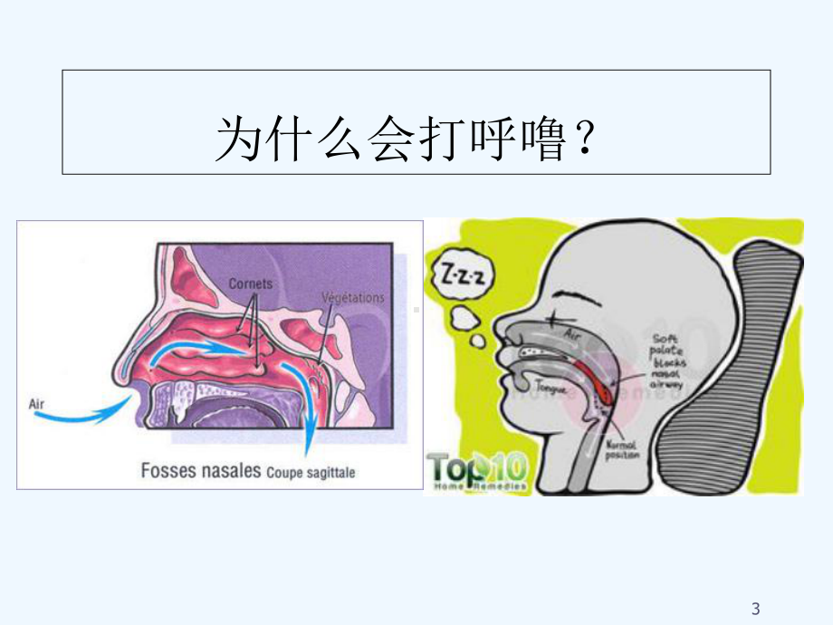 腺样体肥大-课件.ppt_第3页