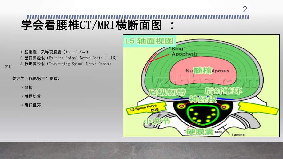 腰椎间盘突出影像课件.ppt_第2页