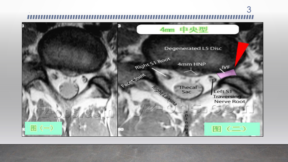 腰椎间盘突出影像课件.ppt_第3页