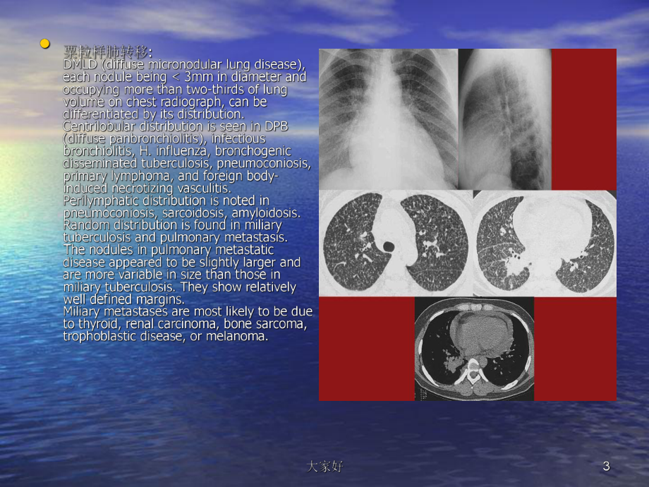 肺部转移瘤的影像诊断-课件.ppt_第3页