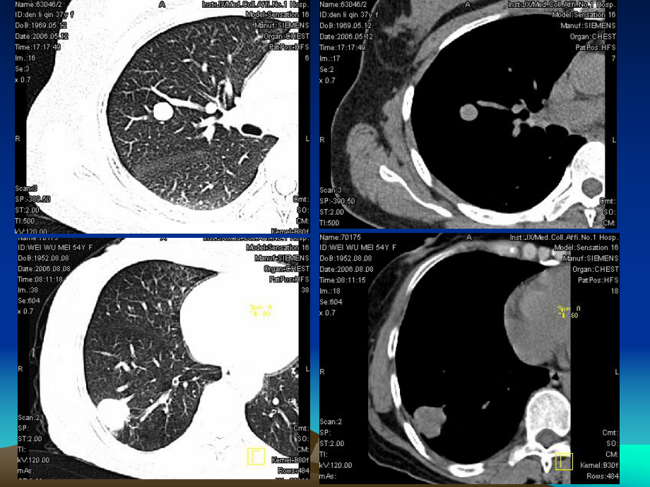 肺结节的CT诊断和鉴别诊断课件-参考.ppt_第3页