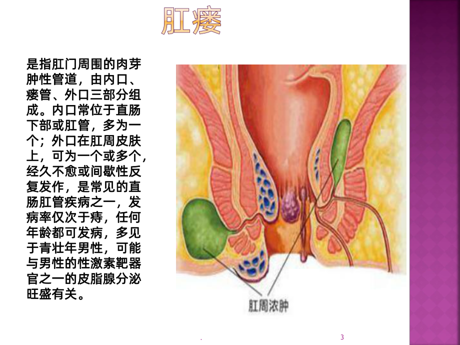 肛瘘护理查房课件.pptx_第3页