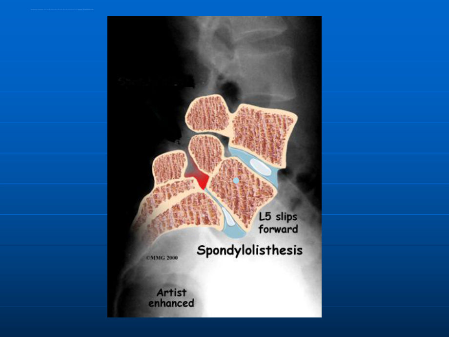 腰椎滑脱症课件.ppt_第3页